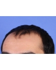 Before Hair Transplant&nbsp;Front